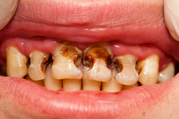 这就是吸烟对牙齿,口腔和牙龈的影响!